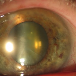 Image cataracte cataract