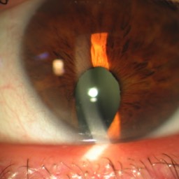 Image Colobome irien