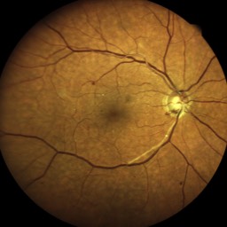 Image Occlusions vasculaires dues au diabète