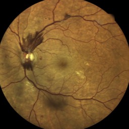 Image Néovaisseaux prépapillaires dus à une rétinopathie diabétique proliférante