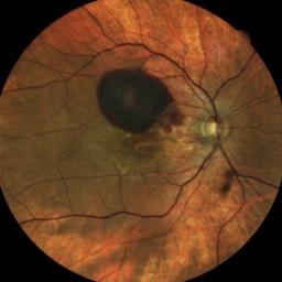 Image Rupture de la membrane de Bruch